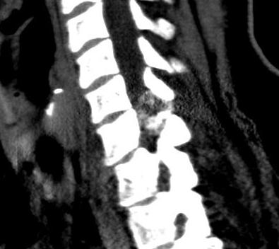 Osteoblastoma CT 1